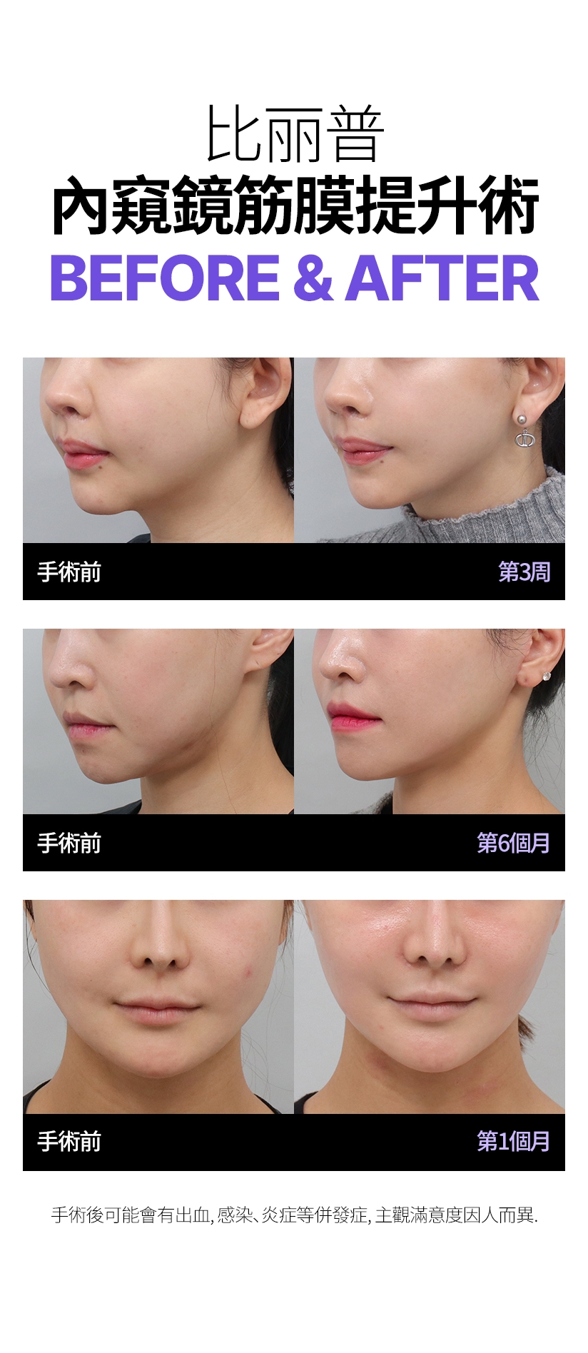 比丽普 內窺鏡筋膜提升術 BEFORE &AFTER 手術後可能會有出血、感染、炎症等併發症，主觀滿意度因人而異。