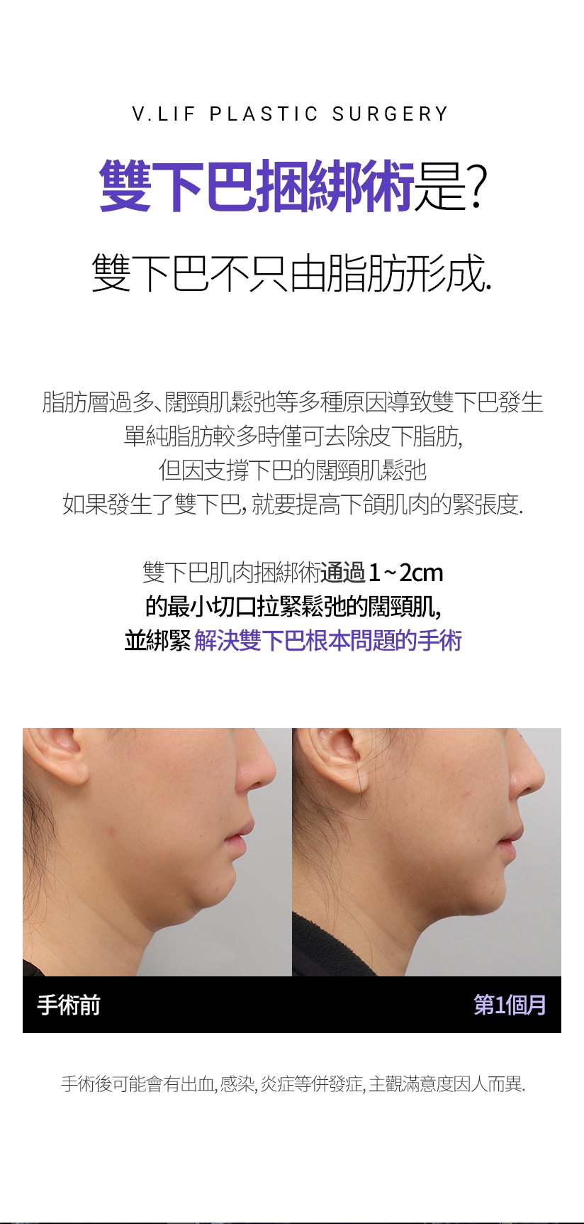 雙下巴捆綁術是？ 雙下巴不只由脂肪形成 脂肪層過多、闊頸肌鬆弛等多種原因導致雙下巴發生 單純脂肪較多時僅可去除皮下脂肪，但因支撐下巴的闊頸肌鬆弛 如果發生了雙下巴，就要提高下頜肌肉的緊張度。 雙下巴肌肉捆綁術通過1~2cm的最小切口拉緊鬆弛的闊頸肌,並綁緊。解決雙下巴根本問題的手術 手術後可能會有出血、感染、炎症等併發症，主觀滿意度因人而異。