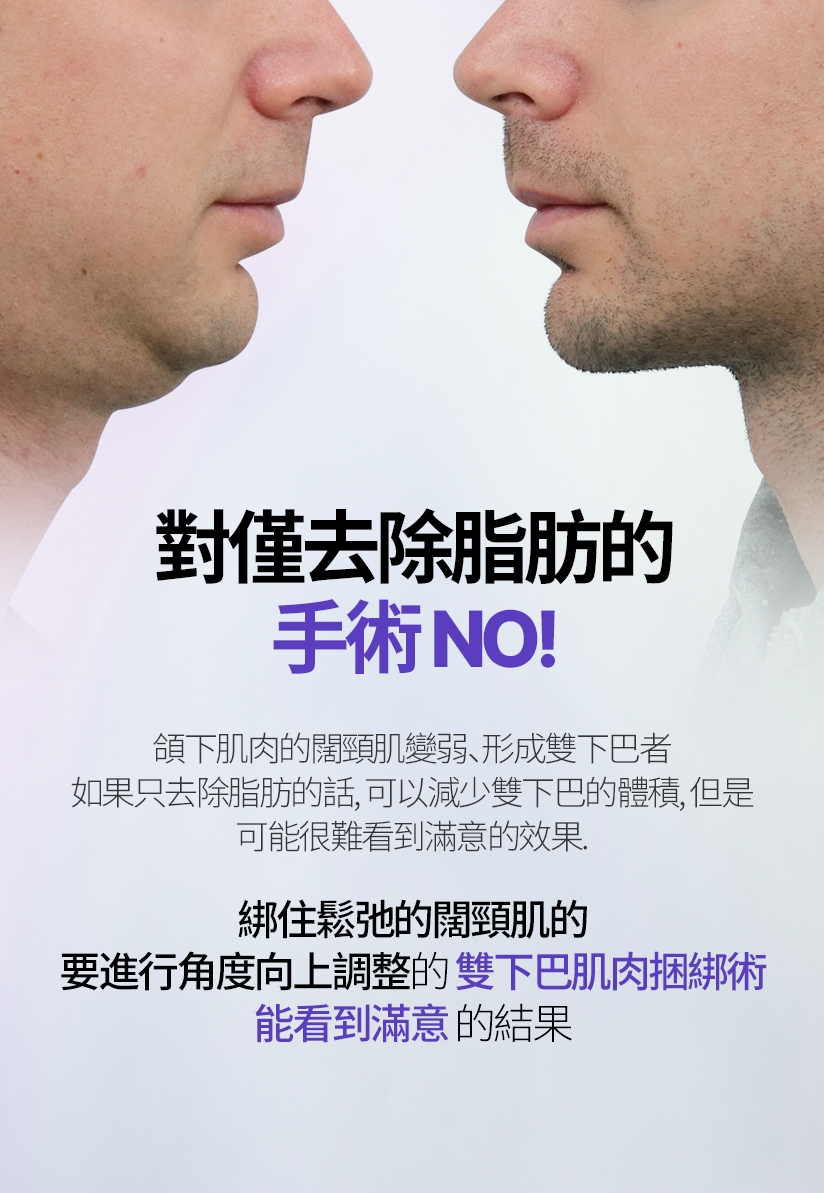 對僅去除脂肪的手術NO！ 頜下肌肉的闊頸肌變弱、形成雙下巴者 如果只去除脂肪的話，可以減少雙下巴的體積，但是 可能很難看到滿意的效果。 綁住鬆弛的闊頸肌的 要進行角度向上調整的雙下巴肌肉捆綁術 能看到滿意的結果
