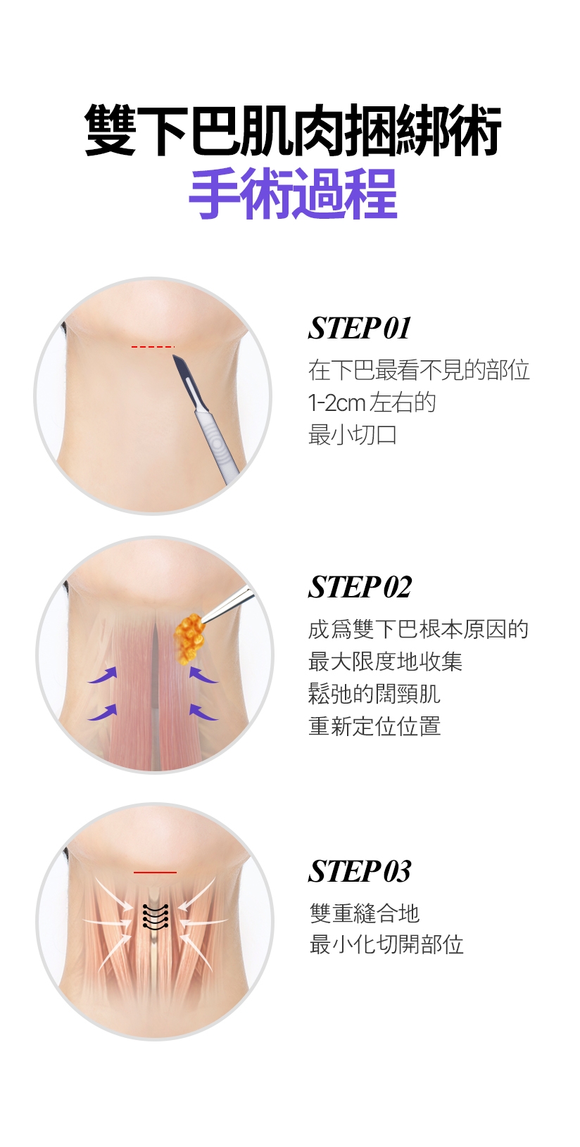 雙下巴肌肉捆綁術手術過程 STEP 01 在下巴最看不見的部位 1-2cm左右的 最小切口 /  STEP 02 成爲雙下巴根本原因的 最大限度地收集鬆弛的闊頸肌 重新定位位置 / STEP 03 雙重縫合地 最小化切開部位