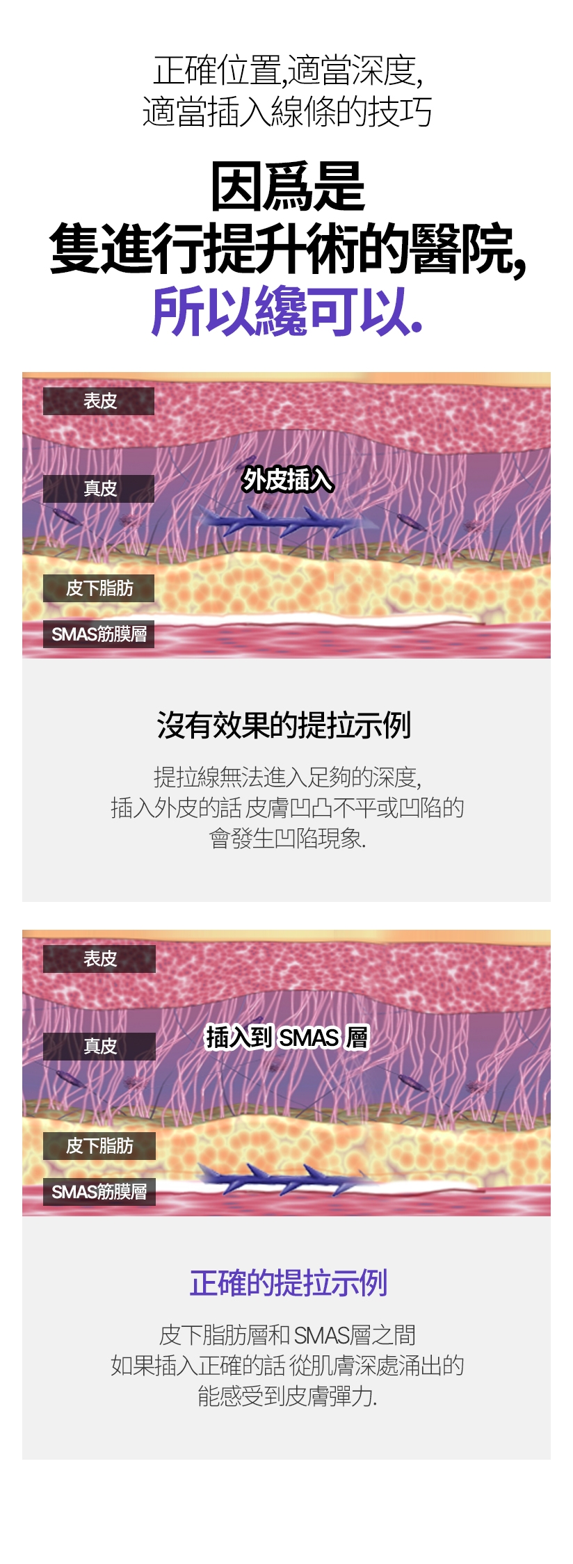 正確位置、適當深度、適當插入線條的技巧 因爲是隻進行提升術的醫院，所以纔可以。 沒有效果的提拉示例 提拉線無法進入足夠的深度，插入外皮的話 皮膚凹凸不平或凹陷的 會發生凹陷現象 正確的提拉示例 皮下脂肪層和SMAS層之間 如果插入正確的話 從肌膚深處涌出的 能感受到皮膚彈力