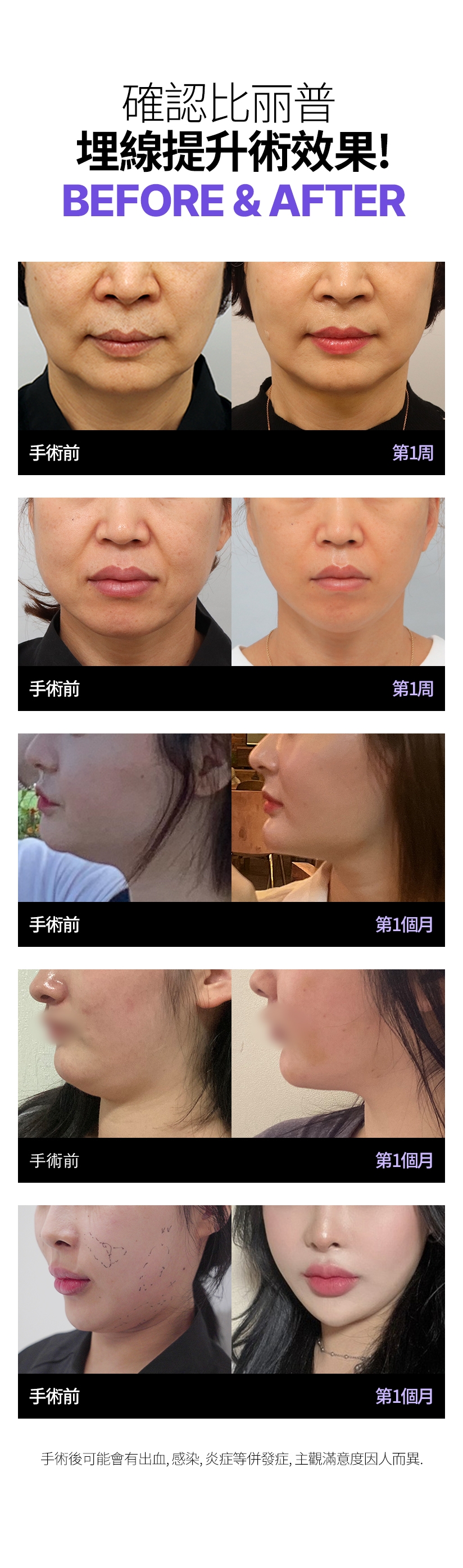 確認比麗普 埋線提升術效果！ BEFORE & AFTER 手術前 - 第1周 手術後可能會有出血、感染、炎症等併發症，主觀滿意度因人而異。